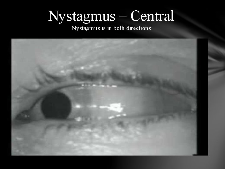 Nystagmus – Central Nystagmus is in both directions 