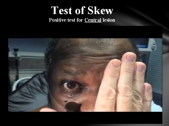 Test of Skew Positive test for Central lesion 