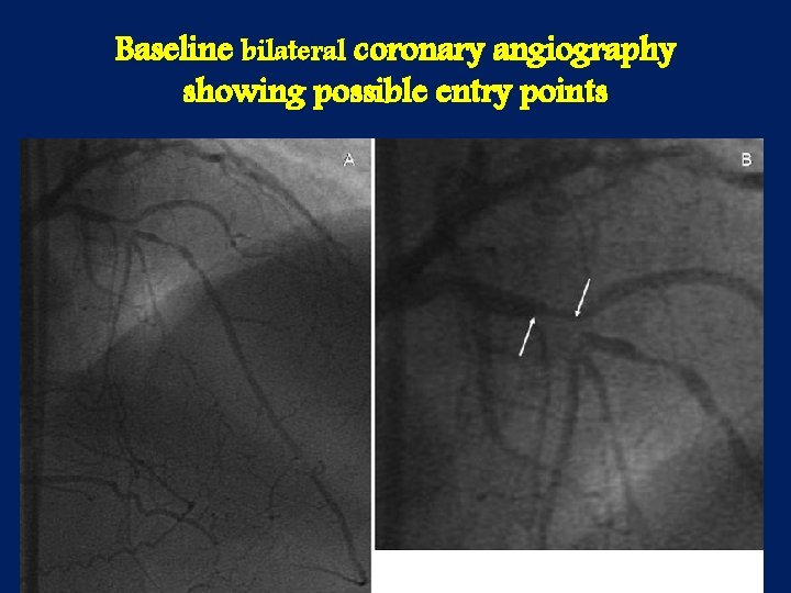 Baseline bilateral coronary angiography showing possible entry points 