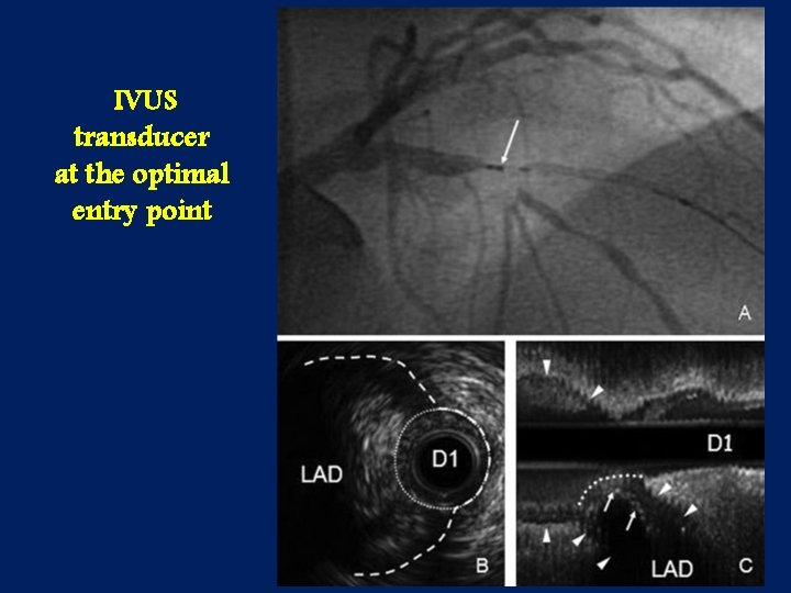 IVUS transducer at the optimal entry point 