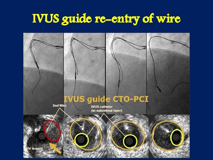 IVUS guide re-entry of wire 