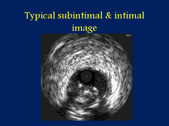 Typical subintimal & intimal image 