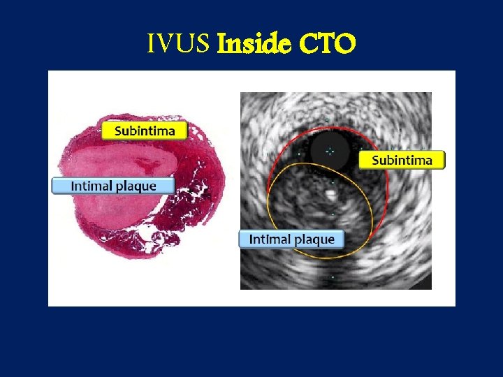 IVUS Inside CTO 