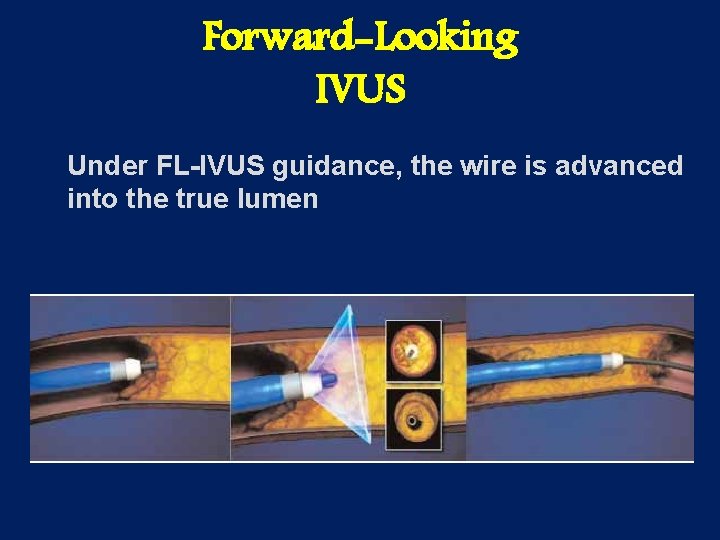 Forward-Looking IVUS Under FL-IVUS guidance, the wire is advanced into the true lumen 