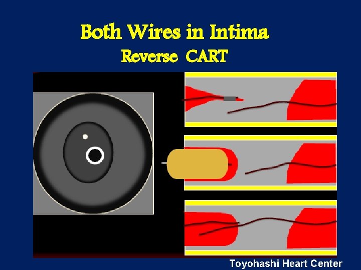 Both Wires in Intima Reverse CART Toyohashi Heart Center 