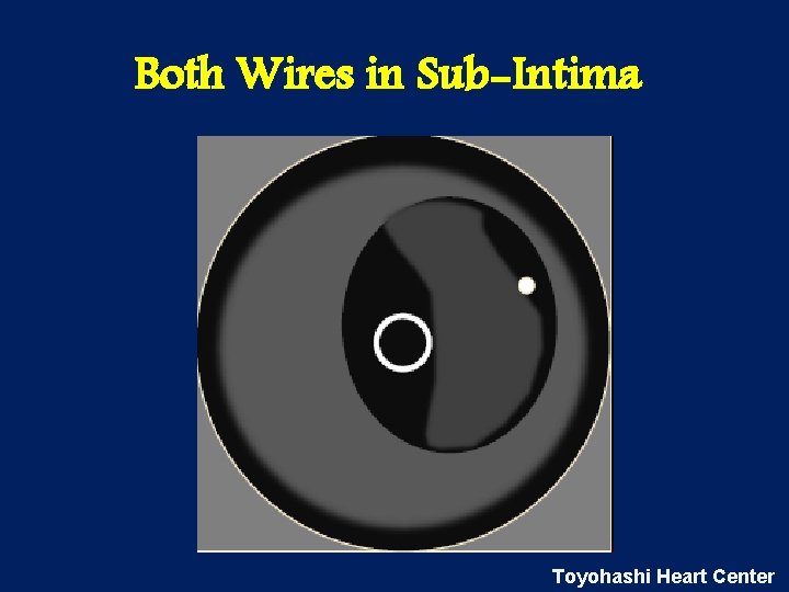 Both Wires in Sub-Intima Toyohashi Heart Center 