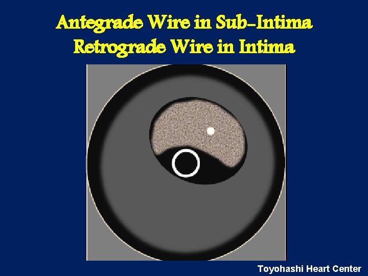 Antegrade Wire in Sub-Intima Retrograde Wire in Intima Toyohashi Heart Center 