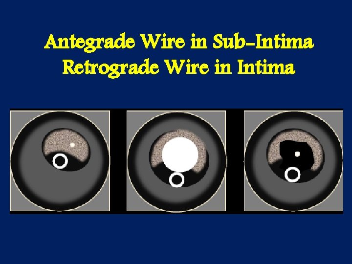 Antegrade Wire in Sub-Intima Retrograde Wire in Intima 