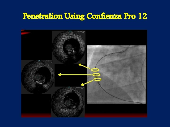 Penetration Using Confienza Pro 12 