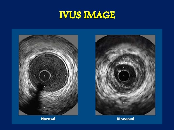 IVUS IMAGE 