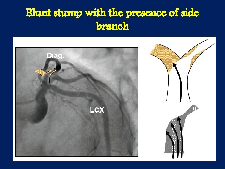 Blunt stump with the presence of side branch 