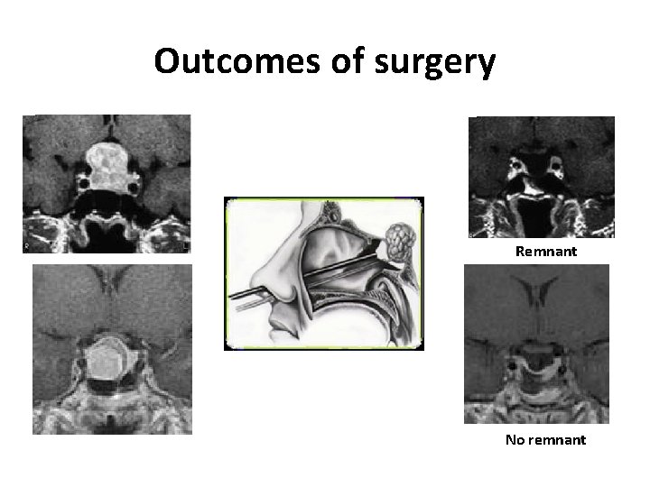 Outcomes of surgery Remnant No remnant 