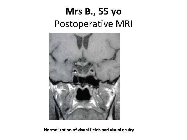 Mrs B. , 55 yo Postoperative MRI Normalization of visual fields and visual acuity