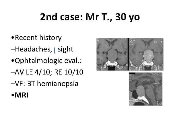 2 nd case: Mr T. , 30 yo • Recent history –Headaches, sight •