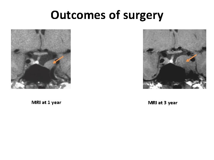 Outcomes of surgery MRI at 1 year MRI at 3 year 