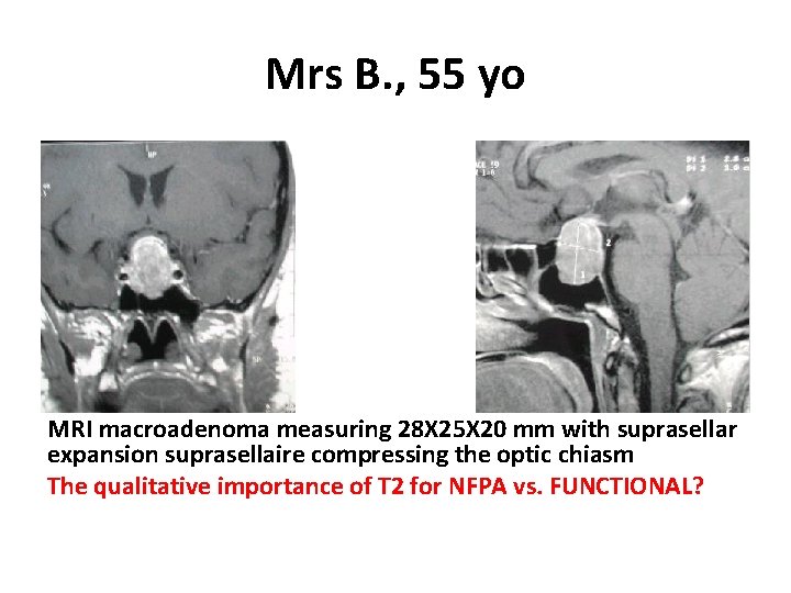 Mrs B. , 55 yo MRI macroadenoma measuring 28 X 25 X 20 mm