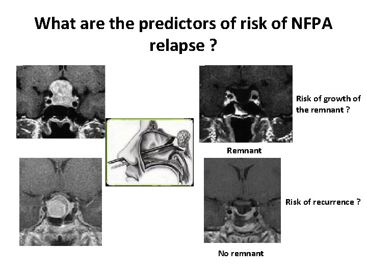 What are the predictors of risk of NFPA relapse ? Risk of growth of