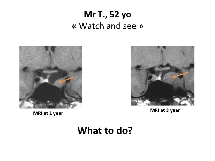 Mr T. , 52 yo « Watch and see » MRI at 3 year