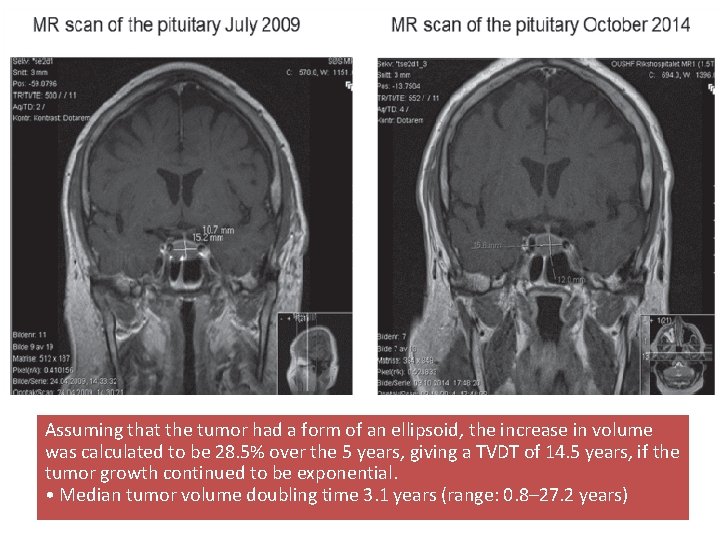 Assuming that the tumor had a form of an ellipsoid, the increase in volume