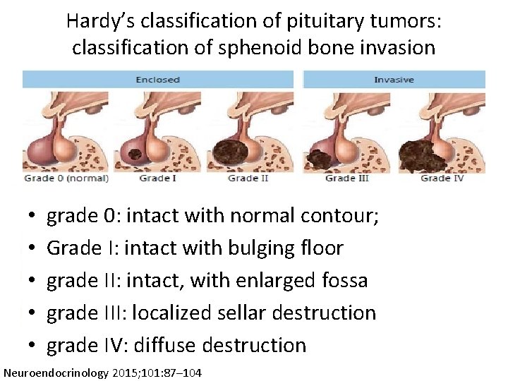 Hardy’s classification of pituitary tumors: classification of sphenoid bone invasion • • • grade