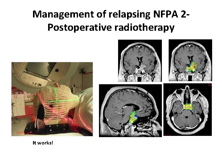 Management of relapsing NFPA 2 Postoperative radiotherapy It works! 