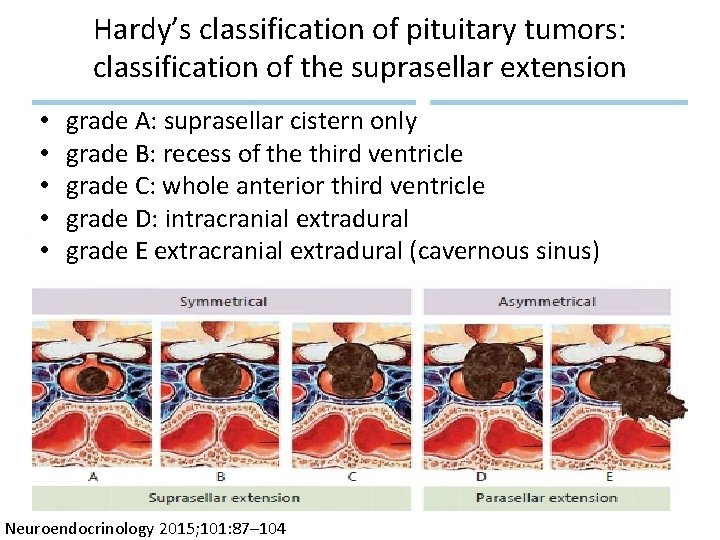 Hardy’s classification of pituitary tumors: classification of the suprasellar extension • • • grade