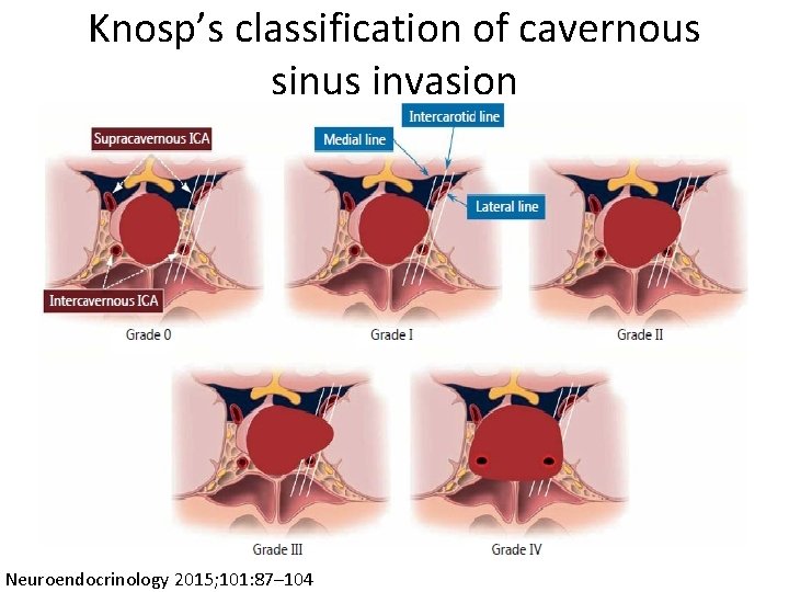 Knosp’s classification of cavernous sinus invasion Neuroendocrinology 2015; 101: 87– 104 