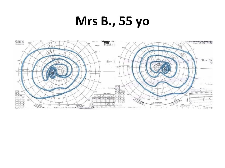 Mrs B. , 55 yo 