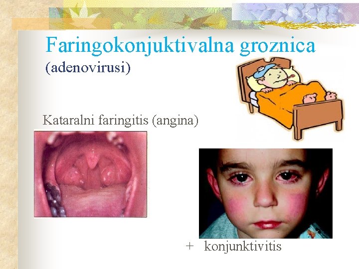 Faringokonjuktivalna groznica (adenovirusi) Kataralni faringitis (angina) + konjunktivitis 