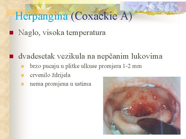 Herpangina (Coxackie A) n Naglo, visoka temperatura n dvadesetak vezikula na nepčanim lukovima n