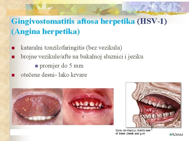 Gingivostomatitis aftosa herpetika (HSV-1) (Angina herpetika) n n n kataralni tonzilofaringitis (bez vezikula) brojne