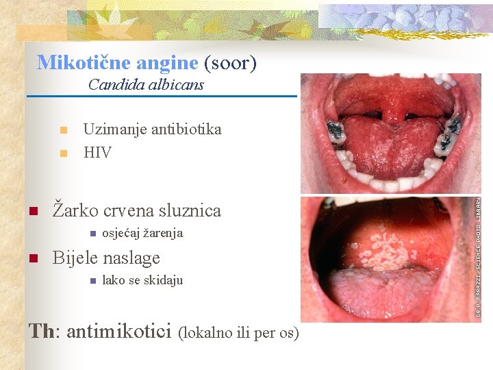 Mikotične angine (soor) Candida albicans n n n Uzimanje antibiotika HIV Žarko crvena sluznica