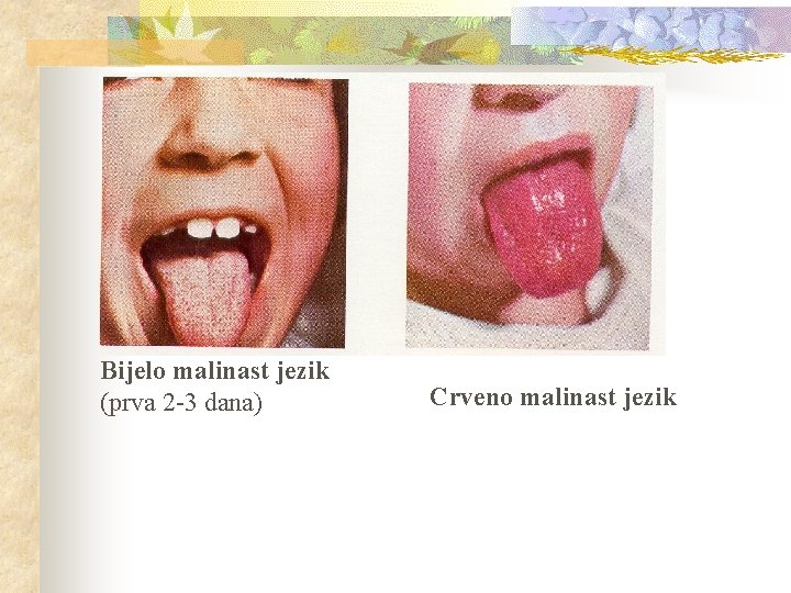Bijelo malinast jezik (prva 2 -3 dana) Crveno malinast jezik 