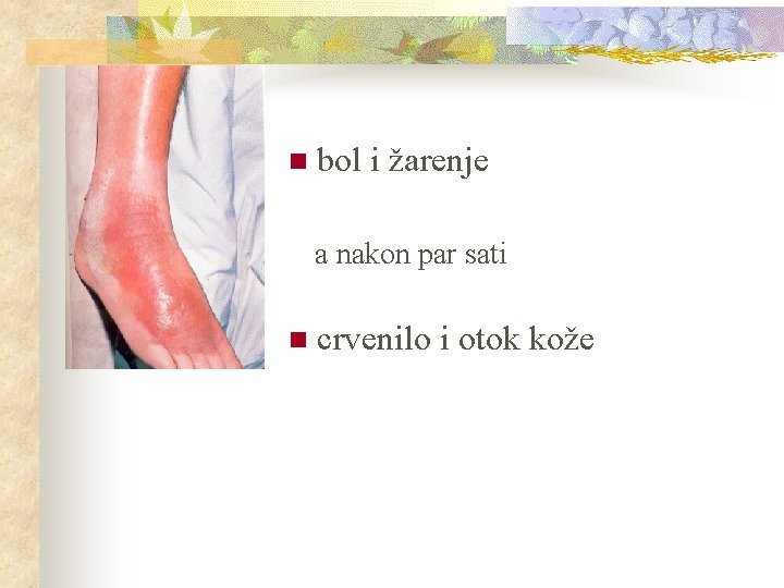 n bol i žarenje a nakon par sati n crvenilo i otok kože 