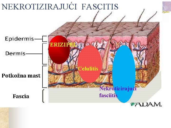 NEKROTIZIRAJUĆI FASCITIS ERIZIPEL Celulitis Potkožna mast Fascia Nekrotizirajući fasciitis 