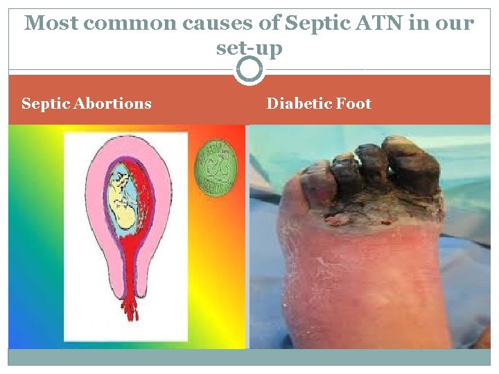 Most common causes of Septic ATN in our set-up Septic Abortions Diabetic Foot 