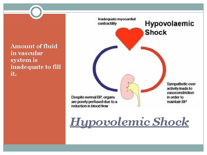 Amount of fluid in vascular system is inadequate to fill it. Hypovolemic Shock 