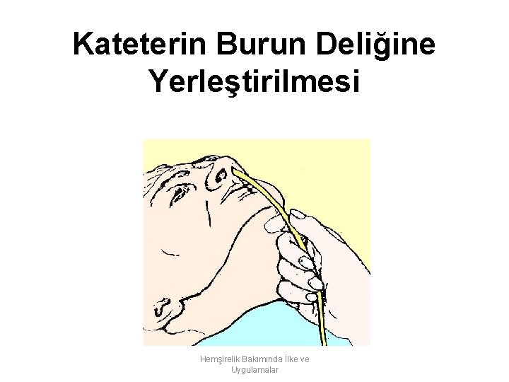 Kateterin Burun Deliğine Yerleştirilmesi Hemşirelik Bakımında İlke ve Uygulamalar 