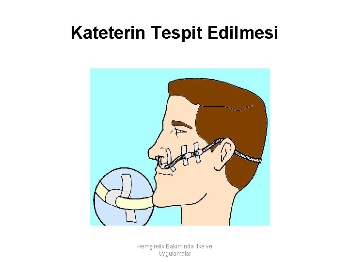 Kateterin Tespit Edilmesi Hemşirelik Bakımında İlke ve Uygulamalar 
