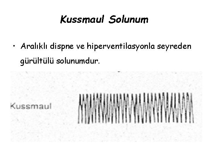 Kussmaul Solunum • Aralıklı dispne ve hiperventilasyonla seyreden gürültülü solunumdur. 