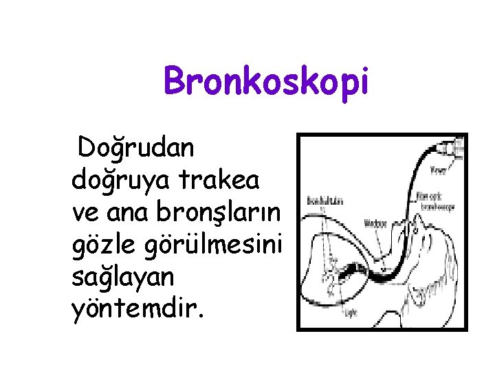 Bronkoskopi Doğrudan doğruya trakea ve ana bronşların gözle görülmesini sağlayan yöntemdir. 