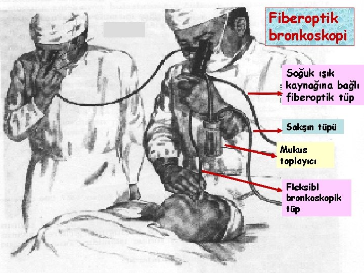 Fiberoptik bronkoskopi Soğuk ışık kaynağına bağlı fiberoptik tüp Sakşın tüpü Mukus toplayıcı Fleksibl bronkoskopik