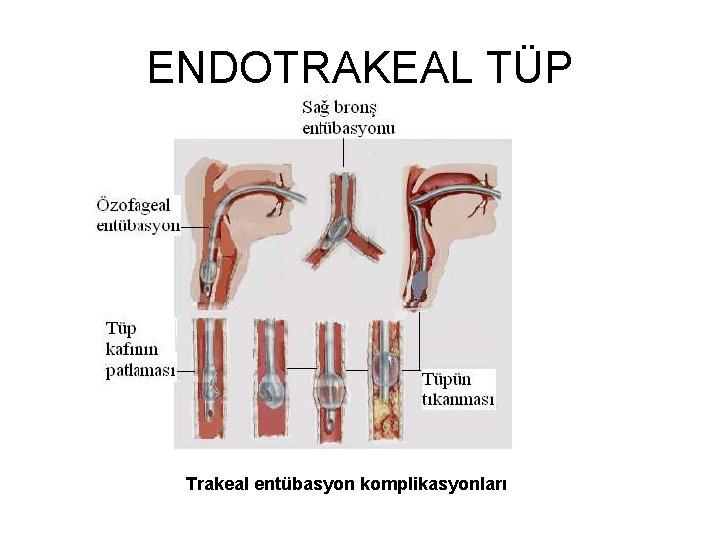 ENDOTRAKEAL TÜP Trakeal entübasyon komplikasyonları 