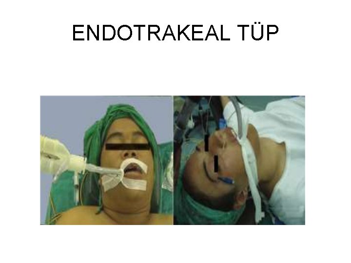 ENDOTRAKEAL TÜP 