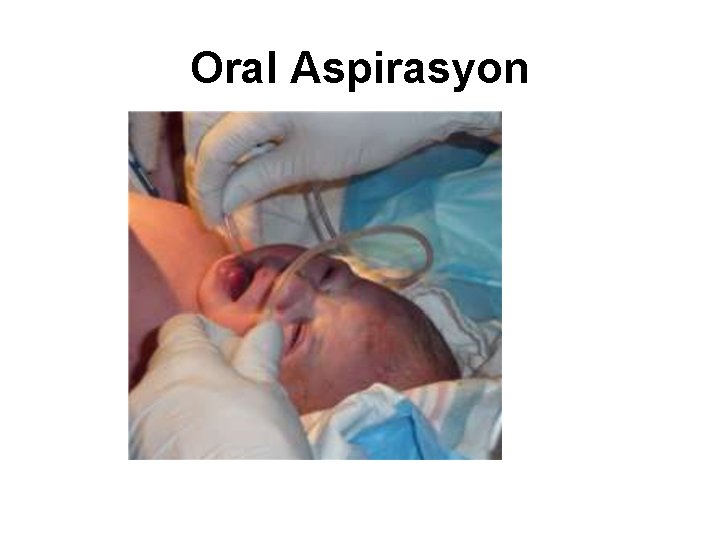 Oral Aspirasyon 