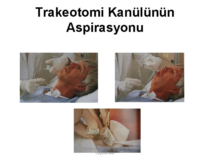 Trakeotomi Kanülünün Aspirasyonu Hemşirelik Bakımında İlke ve Uygulamalar 