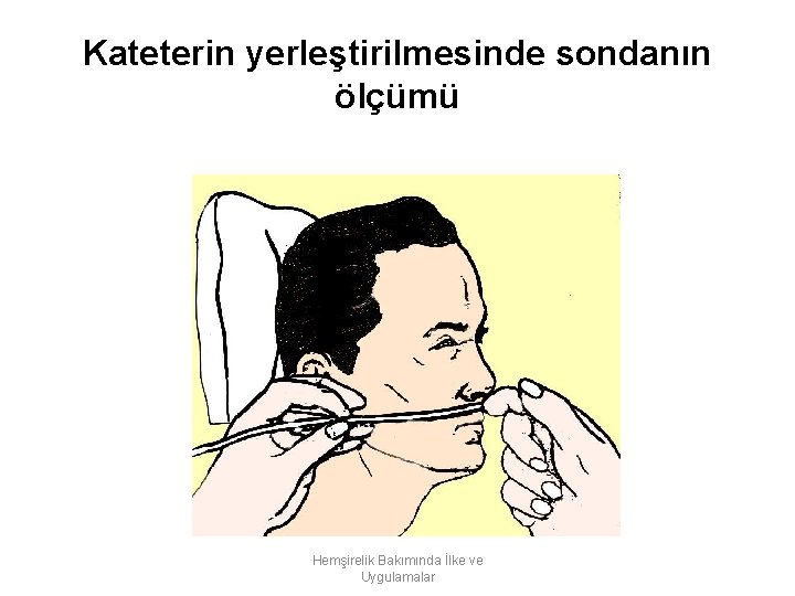 Kateterin yerleştirilmesinde sondanın ölçümü Hemşirelik Bakımında İlke ve Uygulamalar 