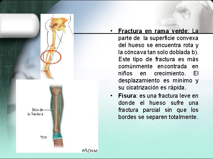  • Fractura en rama verde: La parte de la superficie convexa del hueso