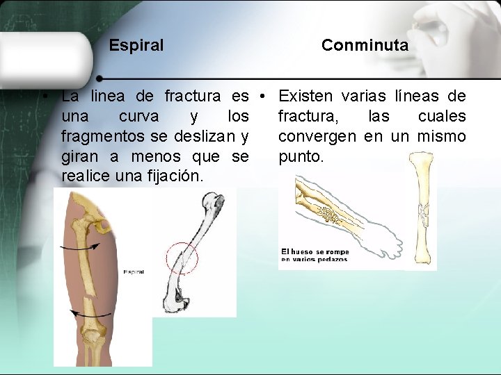 Espiral Conminuta • La linea de fractura es • Existen varias líneas de una