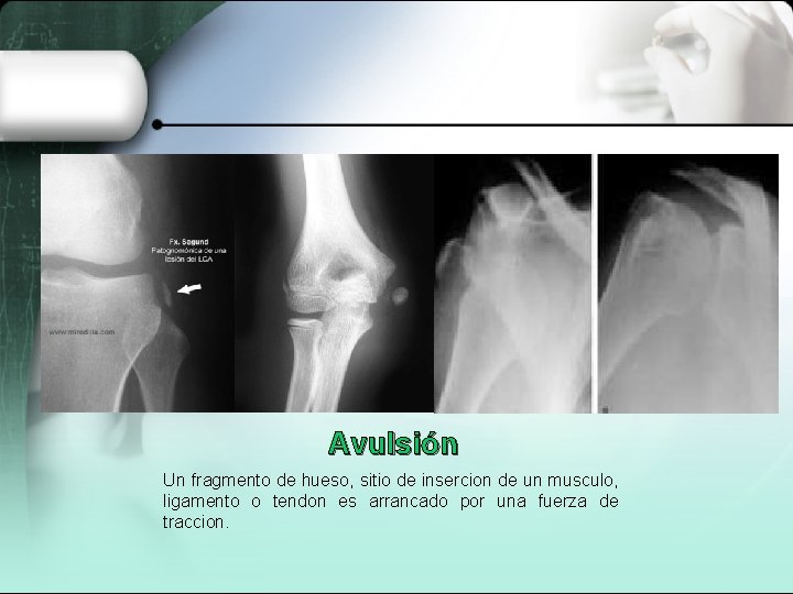 Avulsión Un fragmento de hueso, sitio de insercion de un musculo, ligamento o tendon